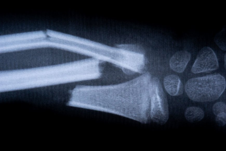 China Develops Revolutionary Bone Glue That Repairs Fractures in Just 3 Minutes